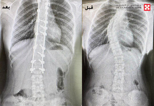 بعد جراحة جنف استغرقت 5 ساعات 