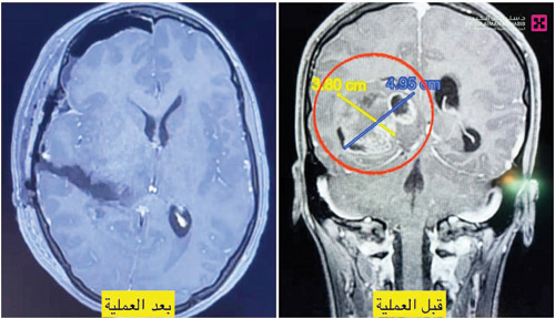 عانت من كتلة ضخمة في الدماغ 